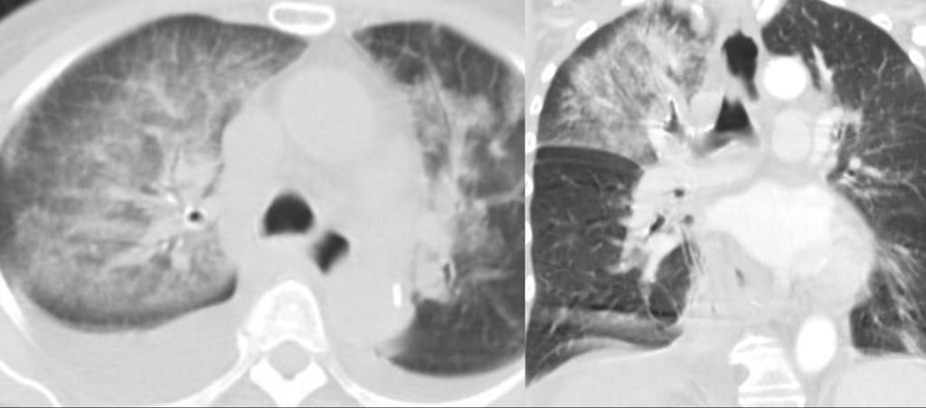 Fig. 6: Thoracic tomography: Central alveolar occupation with