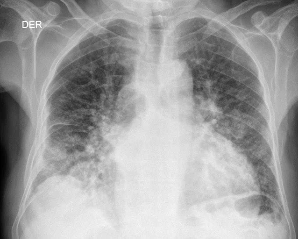 Fig. 8: Chest x-ray: