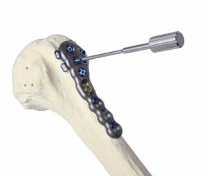 pre-drilled hole. Humeral head fixation in PANTERA was designed with the regional variations in bone density in mind.