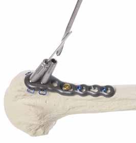 Step 4 Humeral Head Fixation Once the optimal fracture reduction and proper position of the plate and distal fixation have been accomplished, one may proceed with the definitive proximal fracture