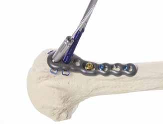 Install the Post through the plate into the humeral head using the Cruciform Driver.