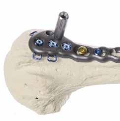 Use the Depth Gauge to determine the proper screw length. Caution: Choose a screw length that is 5mm to 10mm away from the subchondral bone of the joint surface to avoid joint penetration.