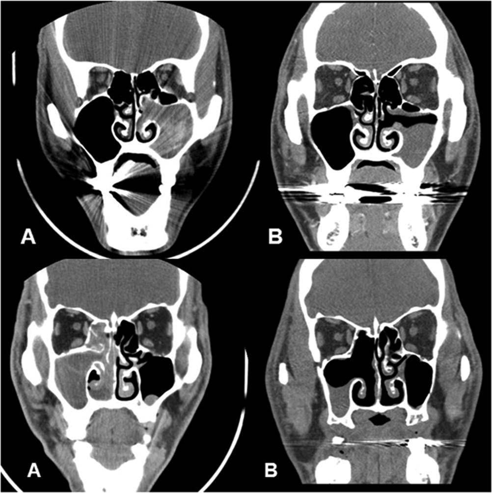 Fig. 3. (A) Preoperative and (B) 12-month postoperative computed tomographic images of two patients who underwent middle meatal antrostomy.
