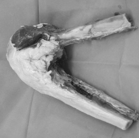5 cm of the proximal fibula, 13 cm of the proximal tibia and 4.5 cm of the distal femur from the knee joint.