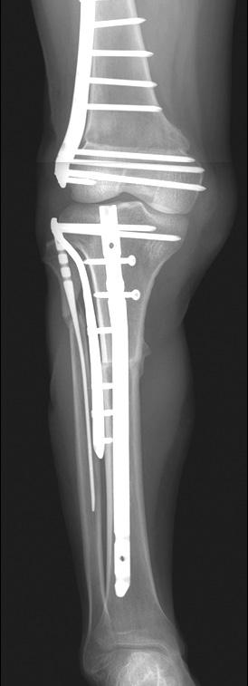 Non-weight bearing two-crutch ambulation was started from two months, and partial weight bearing was permitted 3 months after surgery.