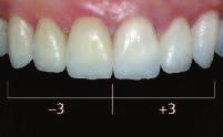 Highly esthetic cementation Variolink Veneer An excellent adhesive bond to the tooth structure and high esthetics are achieved by seating IPS e.