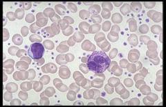 Essential Thrombocytosis Essentials of Diagnosis Elevated platelet count in absence of other causes