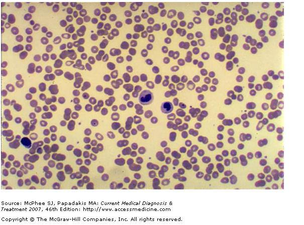 PERIPHERAL BLOOD 50 x.) PMN cellshyposegmentation (socalled Pelger-Huet anomaly) as well as hypogranularity.