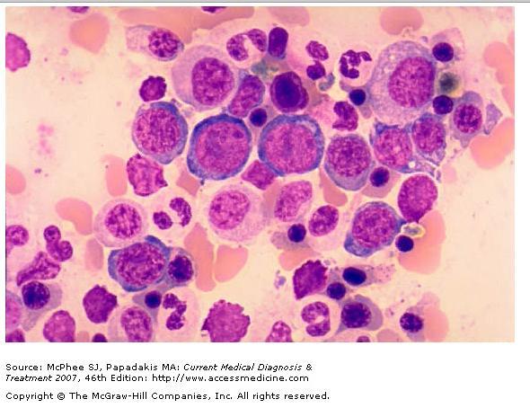Bone Marrow Myelodysplastic syndrome. (Bone marrow aspirate, 100 x.) Increased erythroid cells with basophilic cytoplasm.