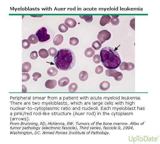 Myeloblasts Immature; large nucleus; prominent