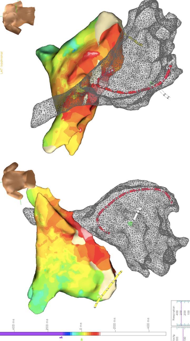 Left atrial activation mapping Left