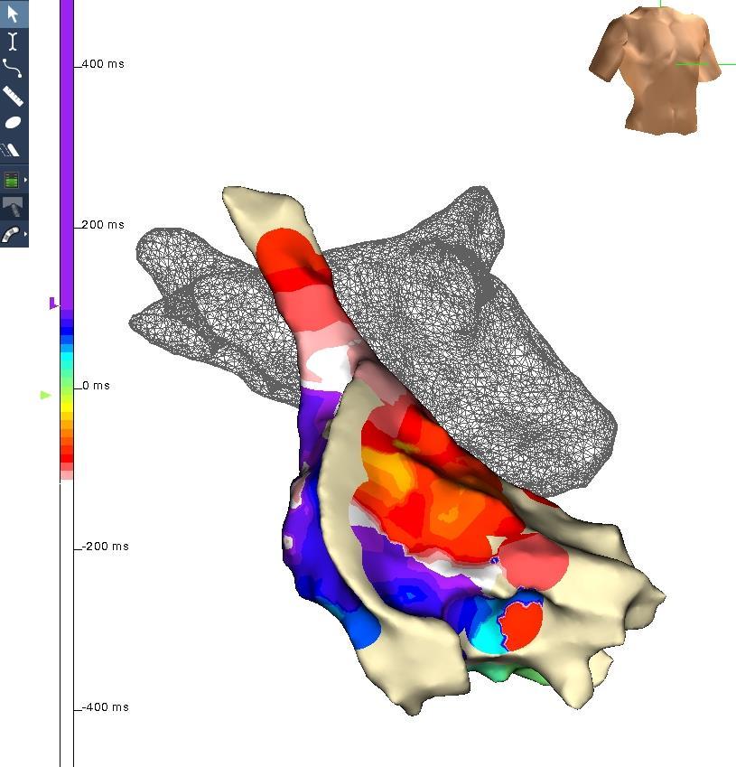 Right atrial activation mapping LA