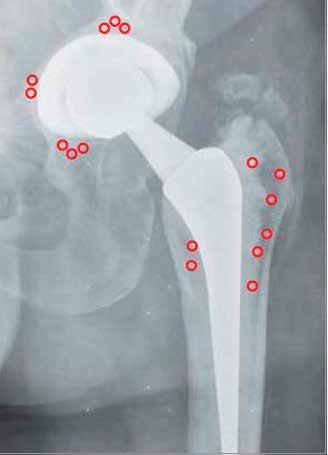 A longitudinal incision roughly a little longer than 10 cm in length is made with a #10 blade on a #3 handle proximal to the greater trochanter and continued distally along the proximal femoral shaft.