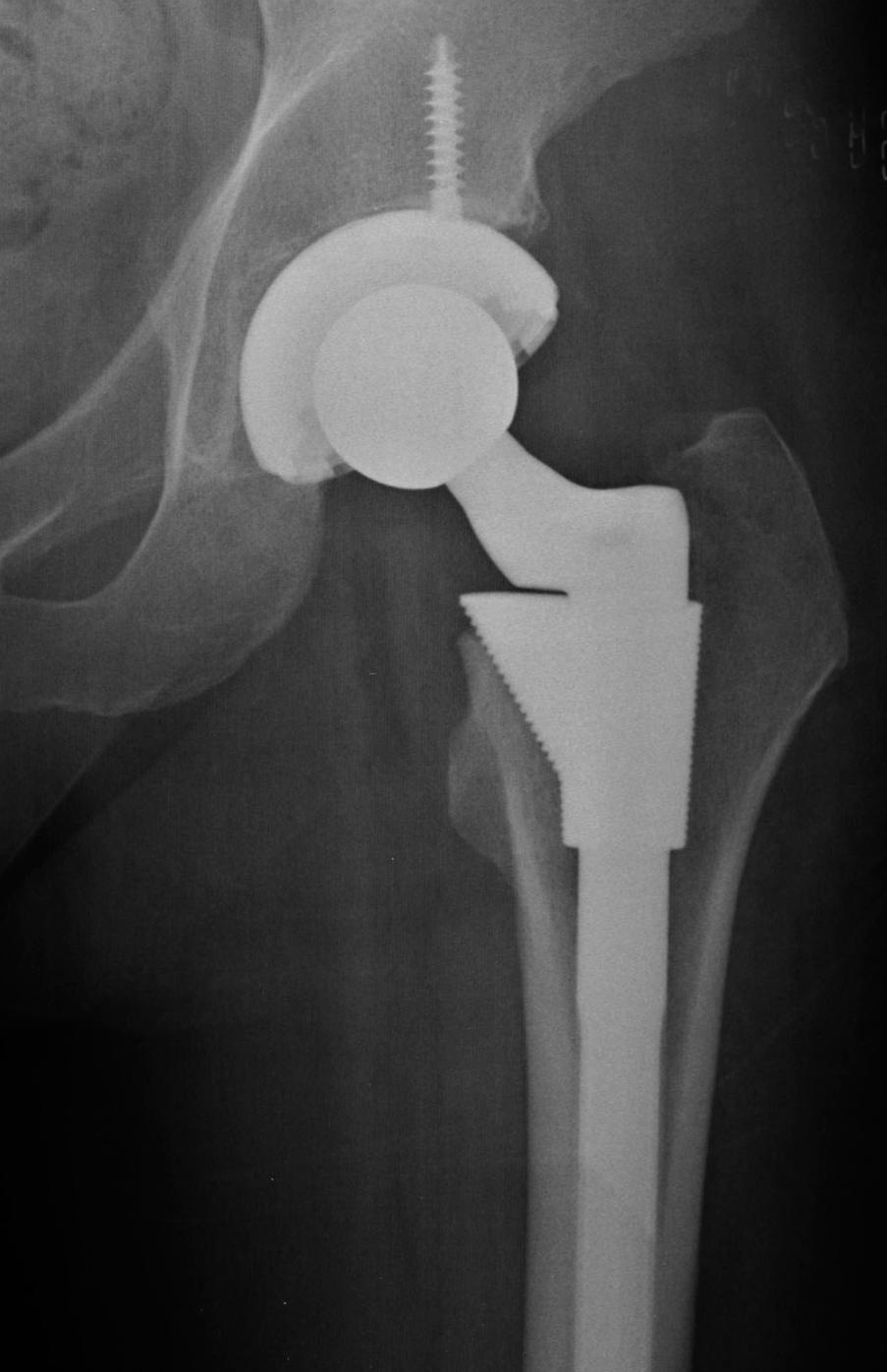 The cup liner of a hip prosthesis shown on a X-ray 162