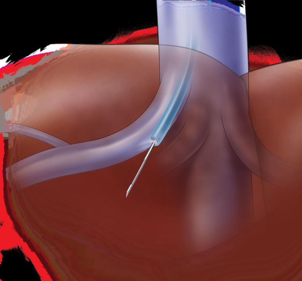 Transjugular liver access and