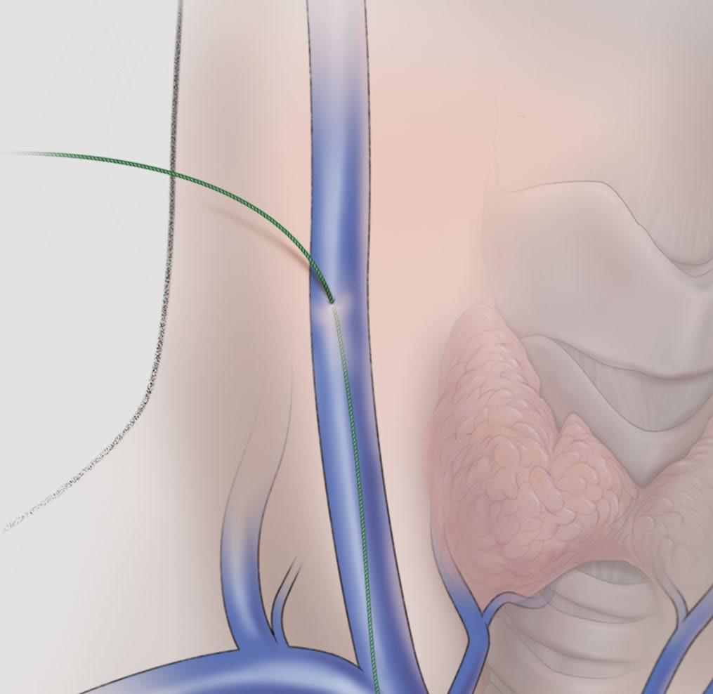 Transjugular liver access and biopsy An illustrated guide Caution: Federal (USA) law restricts the use of these devices to sale by or on the order of a physician.