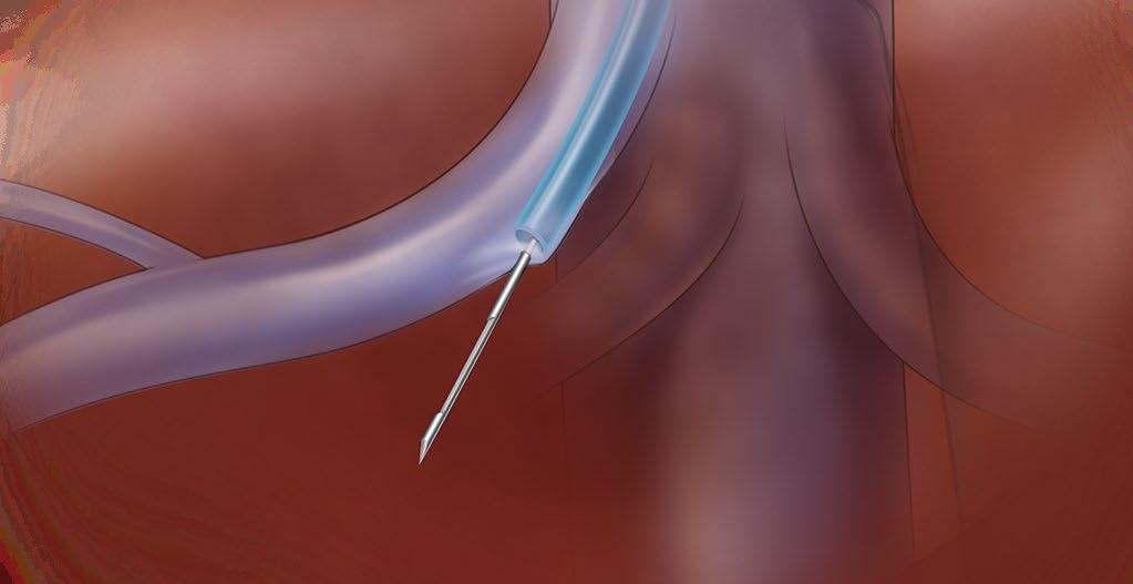 Biopsy Needle, advance the stylet to expose the specimen