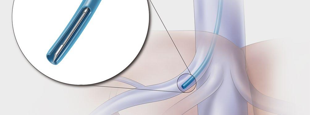 With the stylet fully retracted, advance the Quick-Core Biopsy Needle through