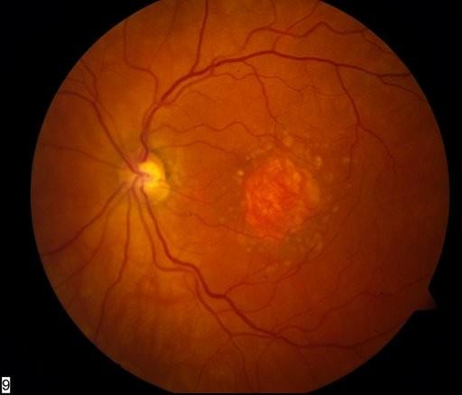 AMD DRY (non-neovascular) Atrophic cell death in the macula No leakage WET