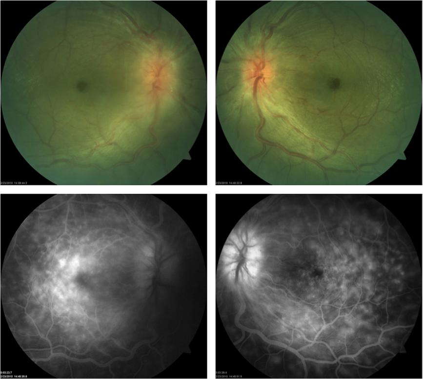 Bourgault et al. Journal of Ophthalmic Inflammation and Infection 2013, 3:61 Page 2 of 5 Figure 1 Color fundus photographs and fluorescein angiogram at presentation.