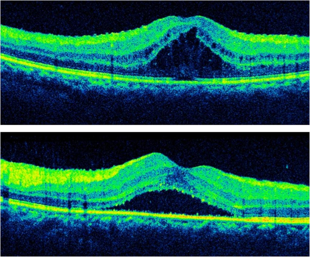 Bourgault et al. Journal of Ophthalmic Inflammation and Infection 2013, 3:61 Page 3 of 5 Figure 2 Optical coherence tomography before bilateral injections of dexamethasone intravitreal implant.