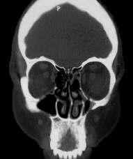 Though the nasal endoscopy reveals considerable anatomical and pathological information, the extent of the disease together with the surrounding anatomy can only be evaluated by the CT scan employing