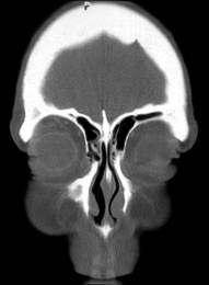 frontal sinus to sphenoid sinus. The CT scan images should be photographed on bone (average 2000H windows) setting as well as soft tissue (average 250H windows) settings.