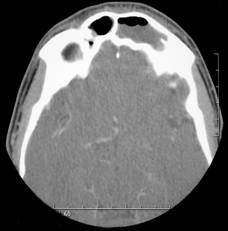 3 of 8 11/3/2008 2:52 PM Fig.9&10(a). Polyps in frontal sinus In acute cases an air fluid level may be visible.
