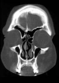 Nasolacrimal duct Recognition of the importance of OMC has increased the role of the radiologist to evaluate and identify different anatomical anomalies as well as pathological process in this key