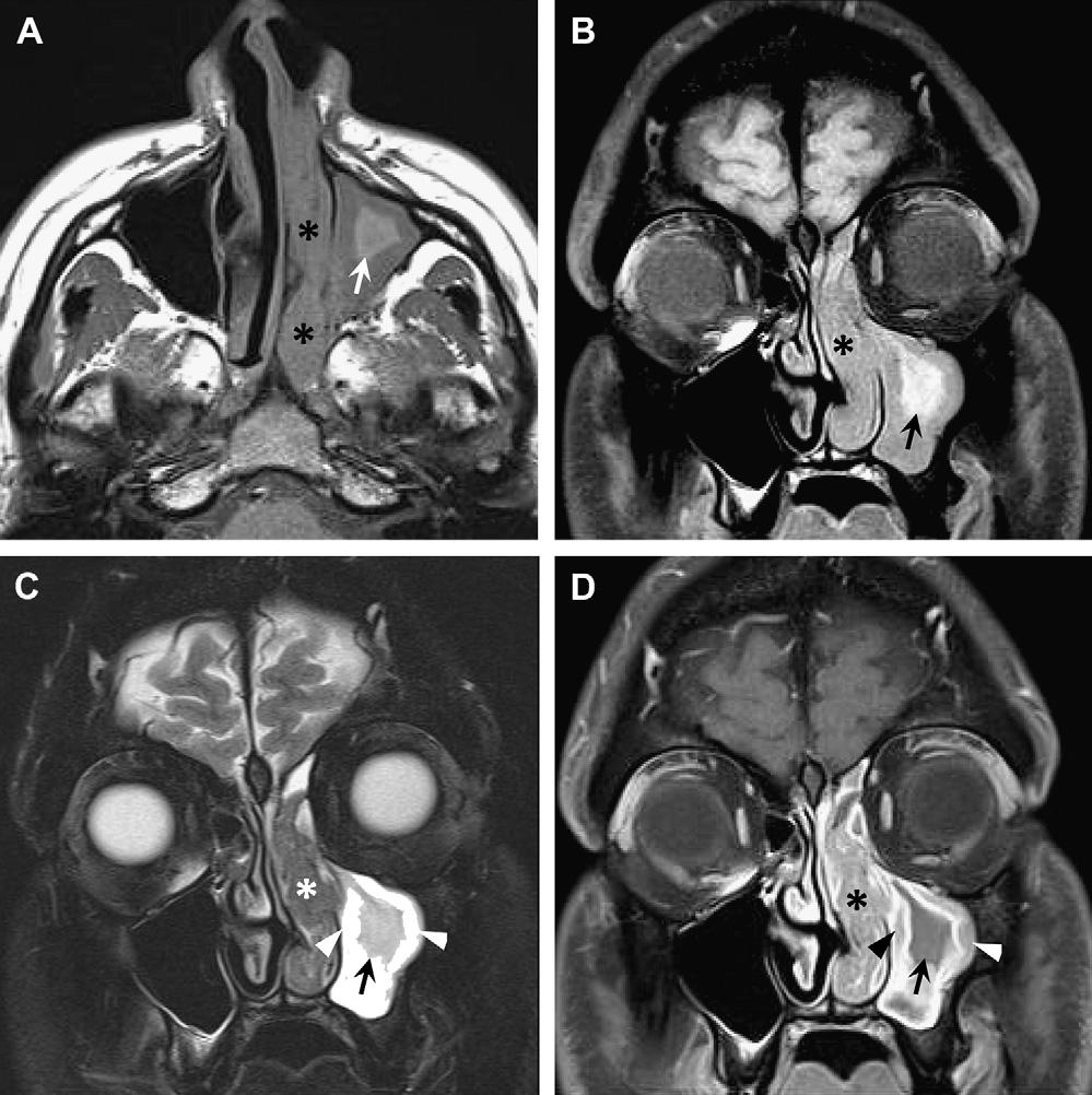 Aggressive Paranasal Sinus Disease 459 imaging features, although the infection typically progresses much more rapidly in the latter.