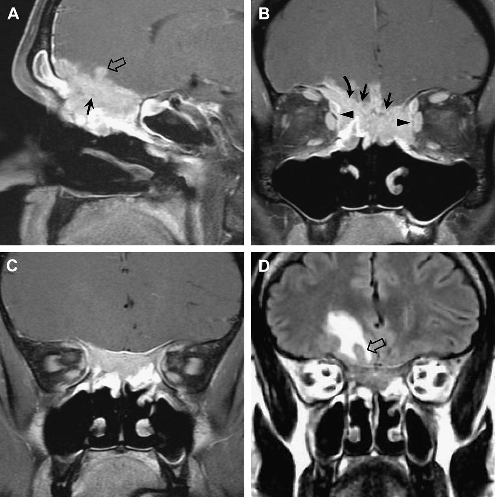 Aggressive Paranasal Sinus Disease 461 It occurs primarily in men in the fourth to sixth decades of life.