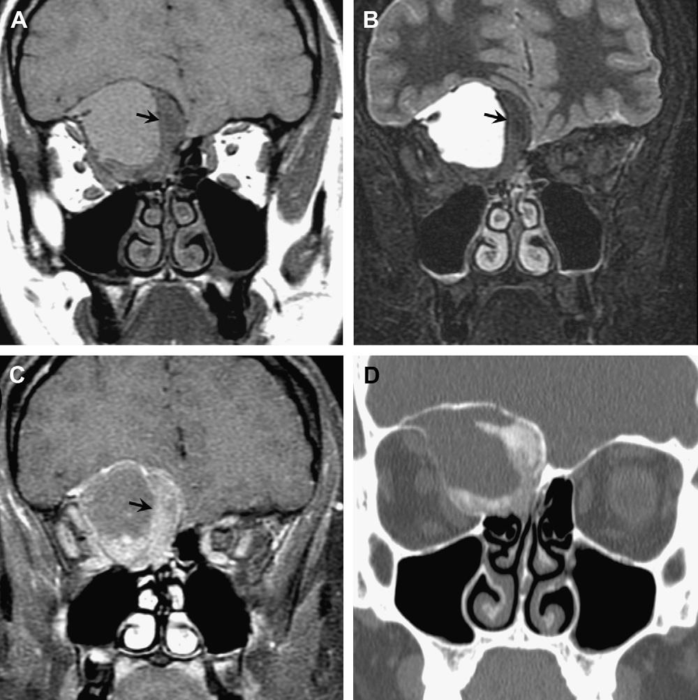 448 Hartman & Gentry The purpose of this article is to explore the differentiating imaging features of aggressive inflammatory versus neoplastic lesions of the paranasal sinuses.