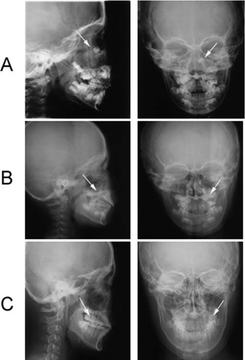 1078 TANIMOTO, MIYAWAKI, IMAI, TAKEDA, TAKANO-YAMAMOTO CASE REPORT FIGURE 1. Cephalometric radiographs. Arrows indicate the impacted premolar. (A) Before marsupialization: (six years three months).