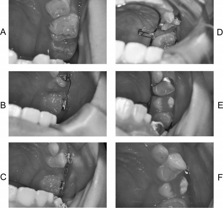 ORTHODONTIC TREATMENT OF A PATIENT WITH KERATOCYST 1081 FIGURE 5. Intraoral photographs during the space regaining for the impacted tooth eruption. (A) Pretreatment: (eight years four months).