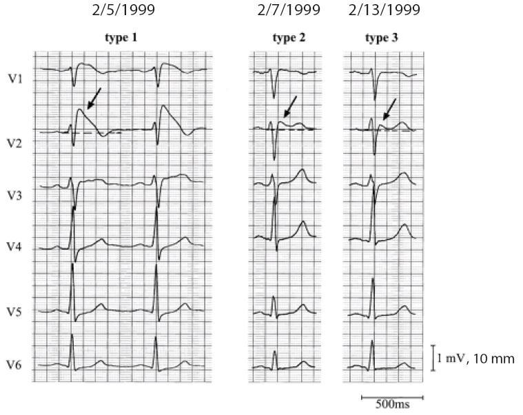 Figure 1.4: Precordial lead recordings of ECG Type 1, 2 and 3. The left panel shows a clear Type-1 ECG, which is diagnostic of the Brugada syndrome.
