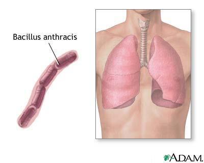 PULMONARY ANTHRAX Inhalation of the dust or filaments of wool from infected animals,