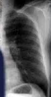 Chest X-ray Chest X-rays is advised as an initial method of inhalation anthrax detection, but it is