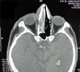 Case report illary sinus, polypoid mucosa of ethmoid sinuses and orbital soft tissue swelling without focal abscess were found during a functional endoscopic surgery.