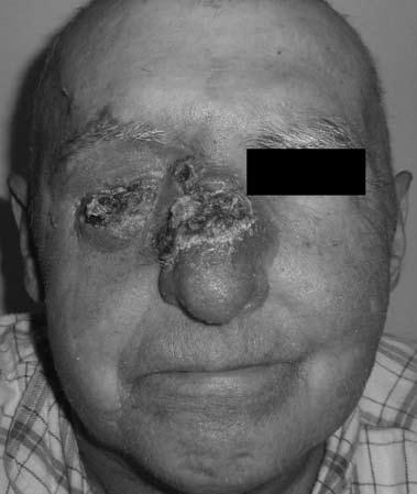 Four months later the patient developed fever, swelling, surface crusting, and widespread necrosis of the right periorbital and nasal area (Figure 2).