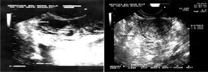Case report drugi operativno, carskim rezom, zbog parcijalne abrupcije posteljice tijekom poroda), jedan spontani pobačaj u 8. tjednu trudnoće, menstrualni ciklusi 30/5.