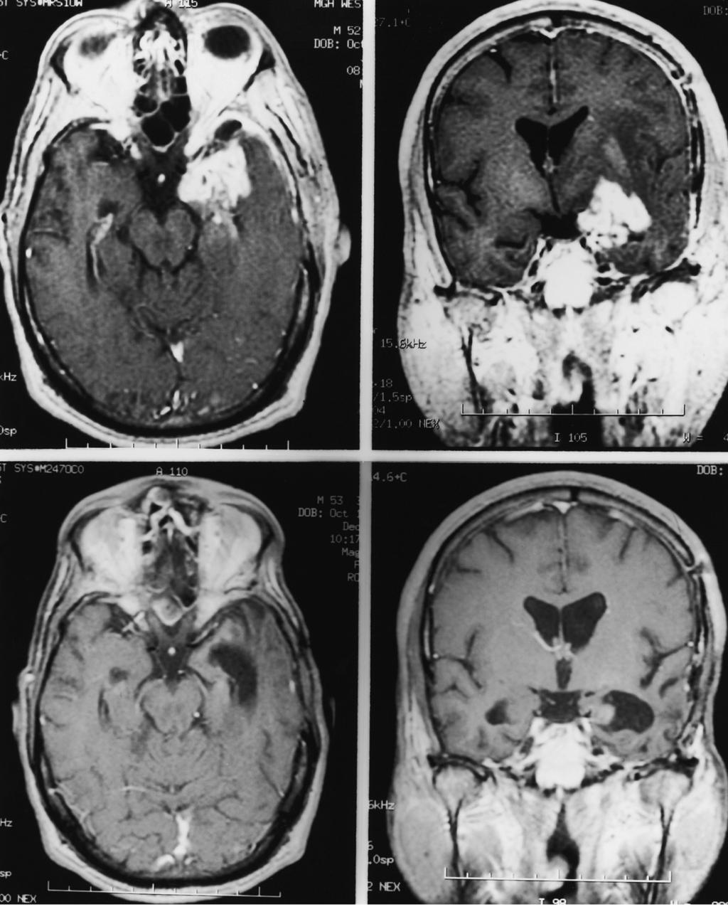 Fig. 1. Axial (L) and coronal (R) MRI images of the 1 patient who had a complete response. Top Panels.