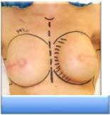 Example:  Chest wall mass and axillary node