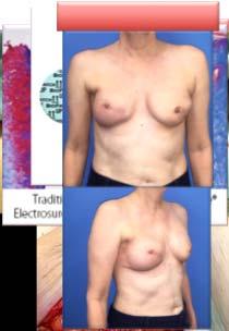 Prosthetic Reconstruction Radiated Breast