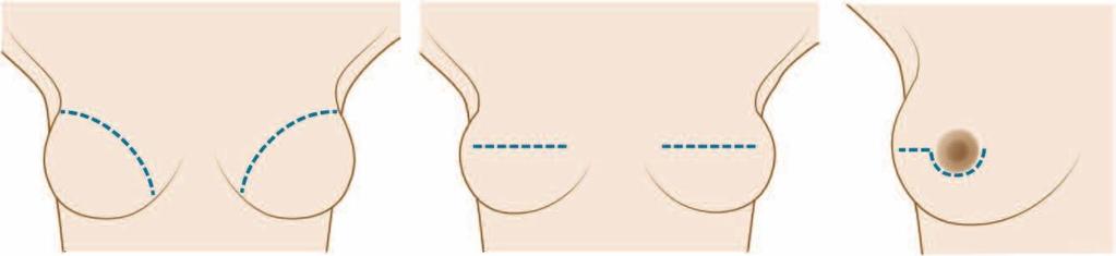 B. All patients that have undergone or will undergo mastectomy are entitled to breast reconstructive surgery covered by insurance (Women s Health Act, 1998).