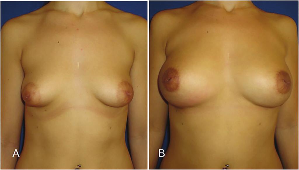 Postoperative view shows a periareolar mastopexy on the right breast and two lipofilling sessions in the left breast at 5 months