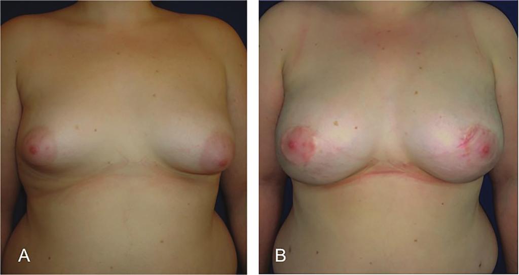 The right photograph is at 5 months after the first lipofilling.