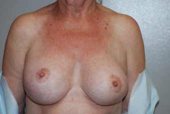 1. Example RM, 65 year old female, s/p masto/aug Unhappy with right side nipple too high, bottomed out Now scheduled with