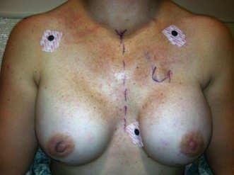 Example Triple Negative Breast Cancer; BRCA+ Had neoadjuvant chemo, Mastectomties, expanders; Post op day 3 implants