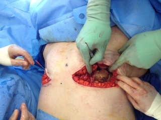 Bilateral capsulectomies done Internal mammary node removal Mass taken with rib