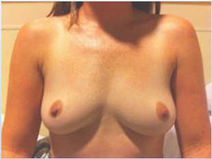 mastectomies/reconstruction Follow for years Then DO the mastectomies when the time